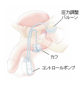 人工尿道括約筋の手術による埋め込み