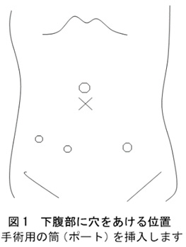 図1 下腹部に穴をあける位置