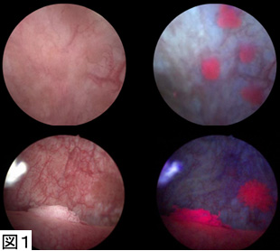 膀胱癌の新しい光力学診断