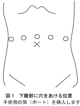 図１ 下腹部に穴をあける位置